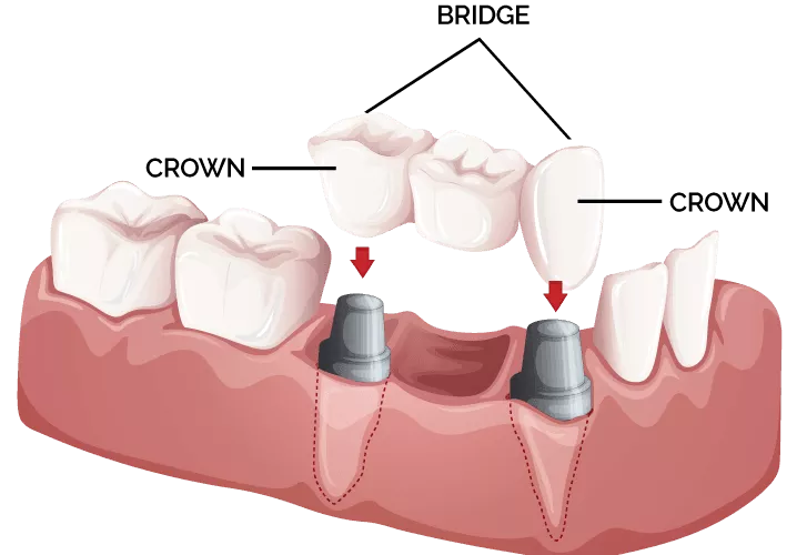https://mzddental.nl/wp-content/uploads/2024/12/53f49e9e07dab01c105c797db7aba8f9.dental-bridge-crowns-santa-ana-727x500-1.webp